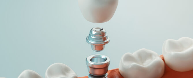 Dental Implants vs. Dentures: Choose Your Smile Solution