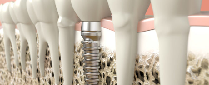 Dental Implants: Enjoy Your Favorite Foods Again
