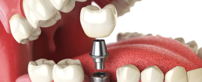 Restore Your Smile: The Power of Dental Implants