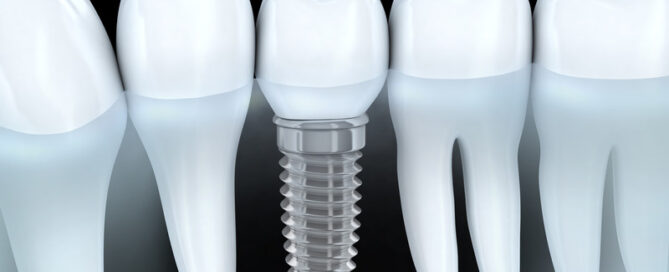 Dental Implants: Cavity-Free Teeth Replacement Option