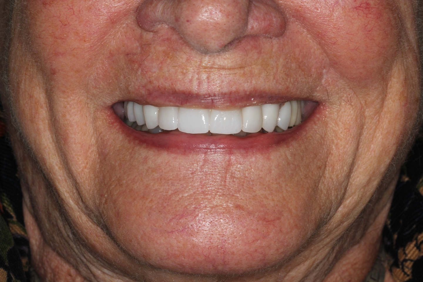 After Dental Implant at Aer Dental Studio Candler NC