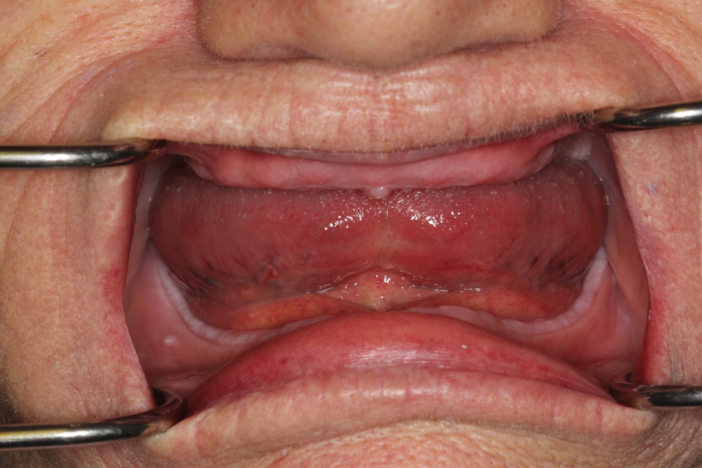 Sherry before All on x at Aer Dental Studio Candler, NC